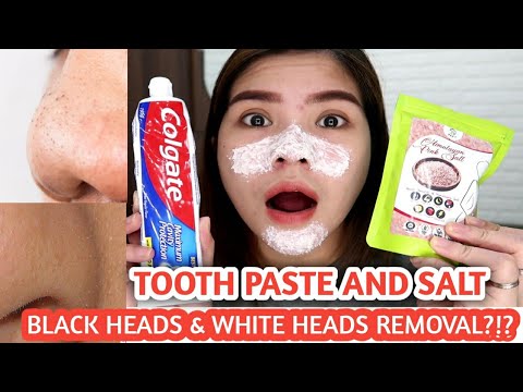 I TRIED TOOTHPASTE AND SALT TO REMOVE BLACK/ WHITE HEADS
